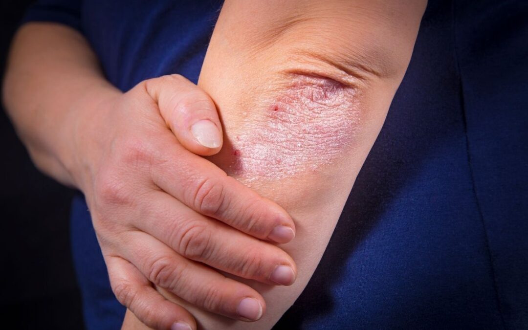 What is Otezla and How Can It Help Patients with Psoriatic Arthritis?