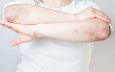 What Are The Different Types Of Psoriatic Arthritis?