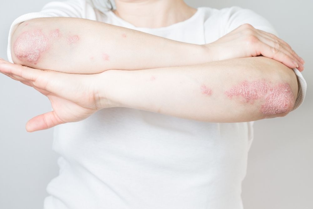 What Are The Different Types Of Psoriatic Arthritis?