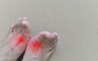 How Long Can Gout Last?