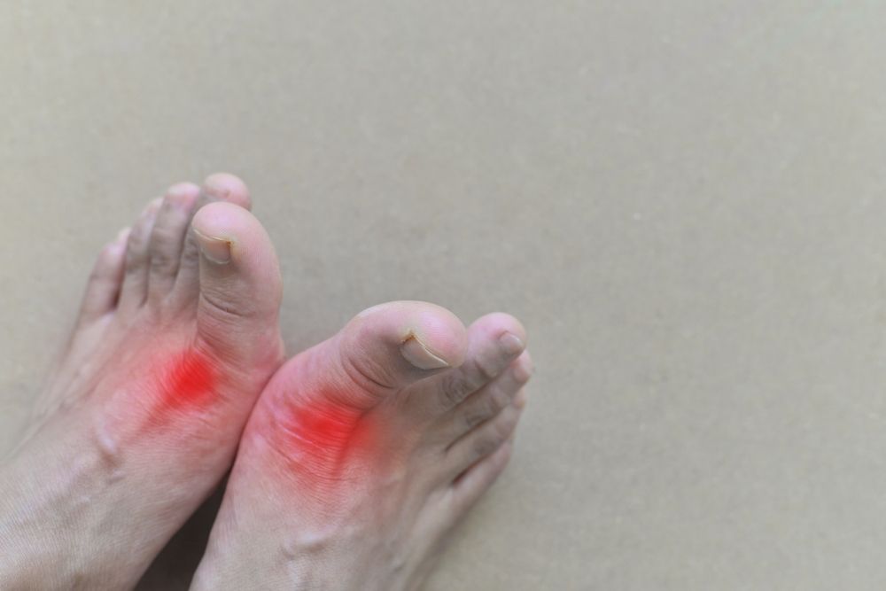 How Long Can Gout Last?