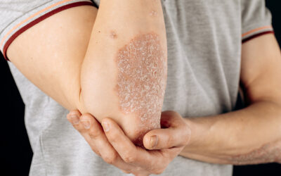 Common Early Signs of Psoriatic Arthritis