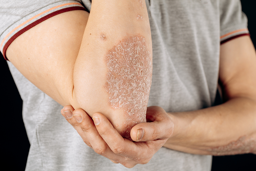 Common Early Signs of Psoriatic Arthritis